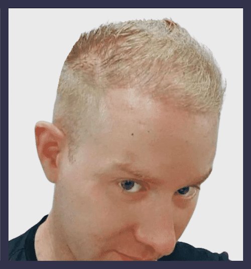 Alex’s Gro Micro-transplant Hair Transplant: 4-Month Update