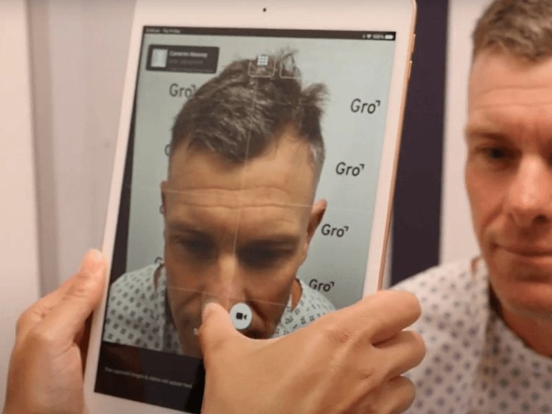 6 Reasons Why People Go Bald