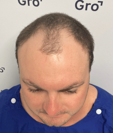 Before image for James