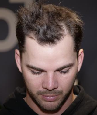 Before image for Matt