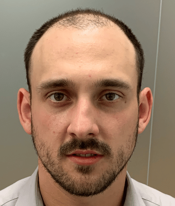 Before image for Matt