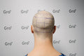 How To Prepare For Your Gro Hair Transplant