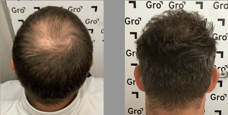 5 Men Reveal Whether the Hair Transplant Was Worth It