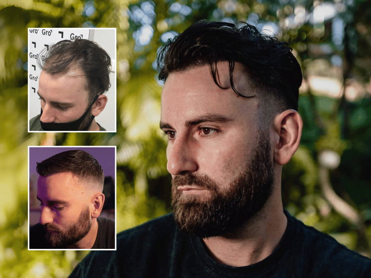Hair Plugs Explained: What They Are vs Modern Hair Transplants
