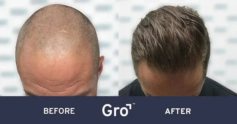 Do Hair Transplants Look Obvious?