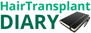 Hair Transplant Diary – Week 1, Transplant 2