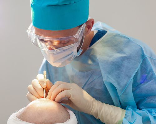 What Is The Success Rate Of A Hair Transplant?