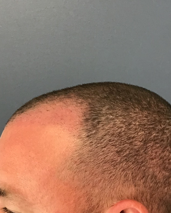 Before treatment