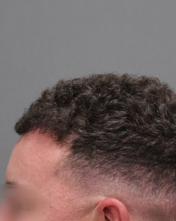 After treatment