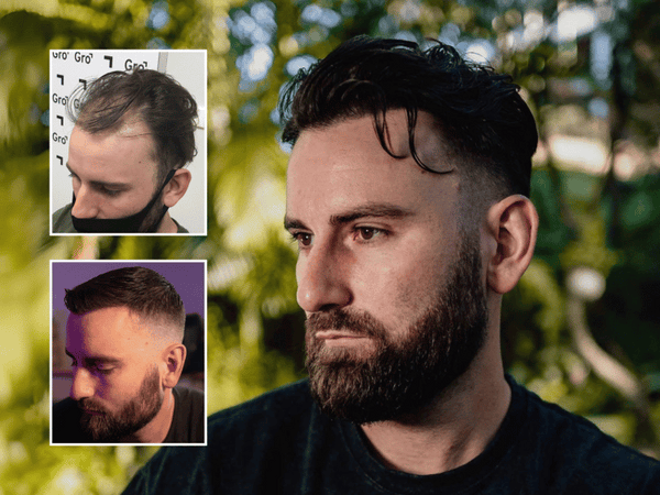 Frontal Hairline Transplant