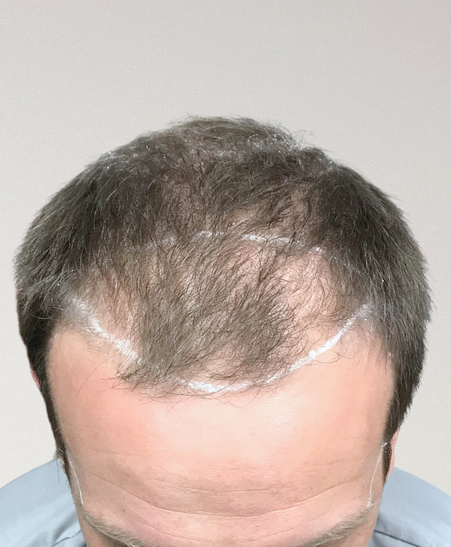 Hair restoration patient before treatment, age 35, receding hairline