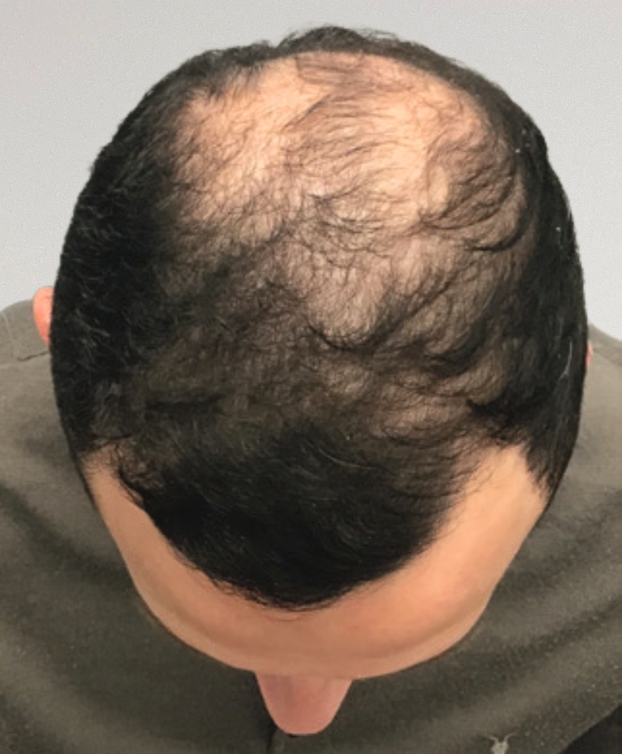 Hair restoration patient before treatment, balding