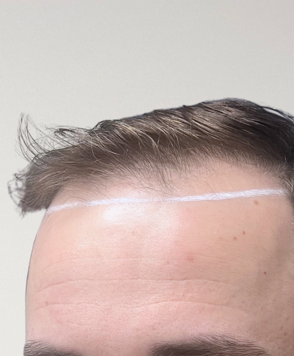 Before treatment