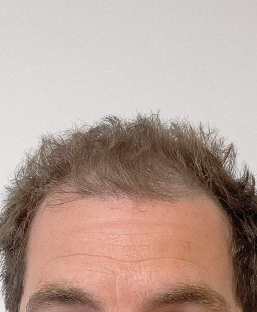 Hair restoration patient before treatment, age 40, thinning