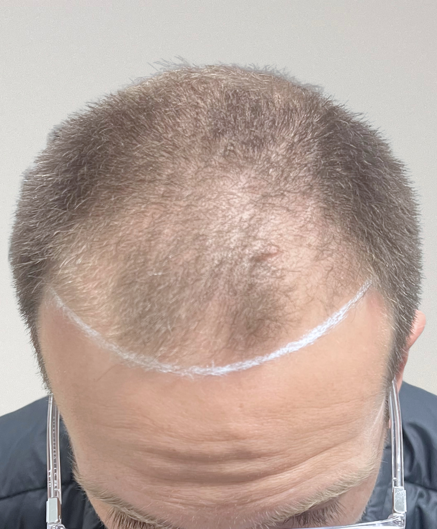 Hair restoration patient before treatment, age 35, receding hairline, balding