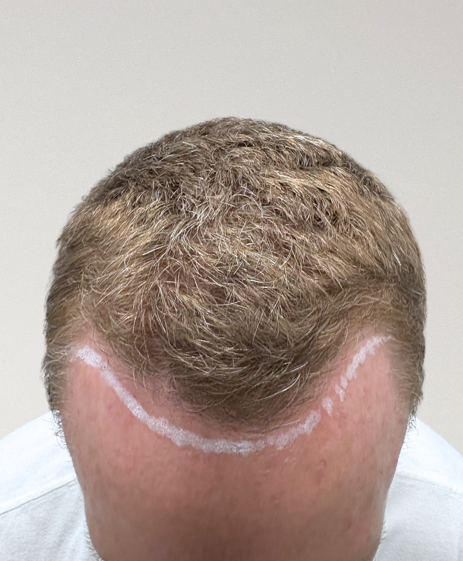 Hair restoration patient before treatment, age 48, receding hairline