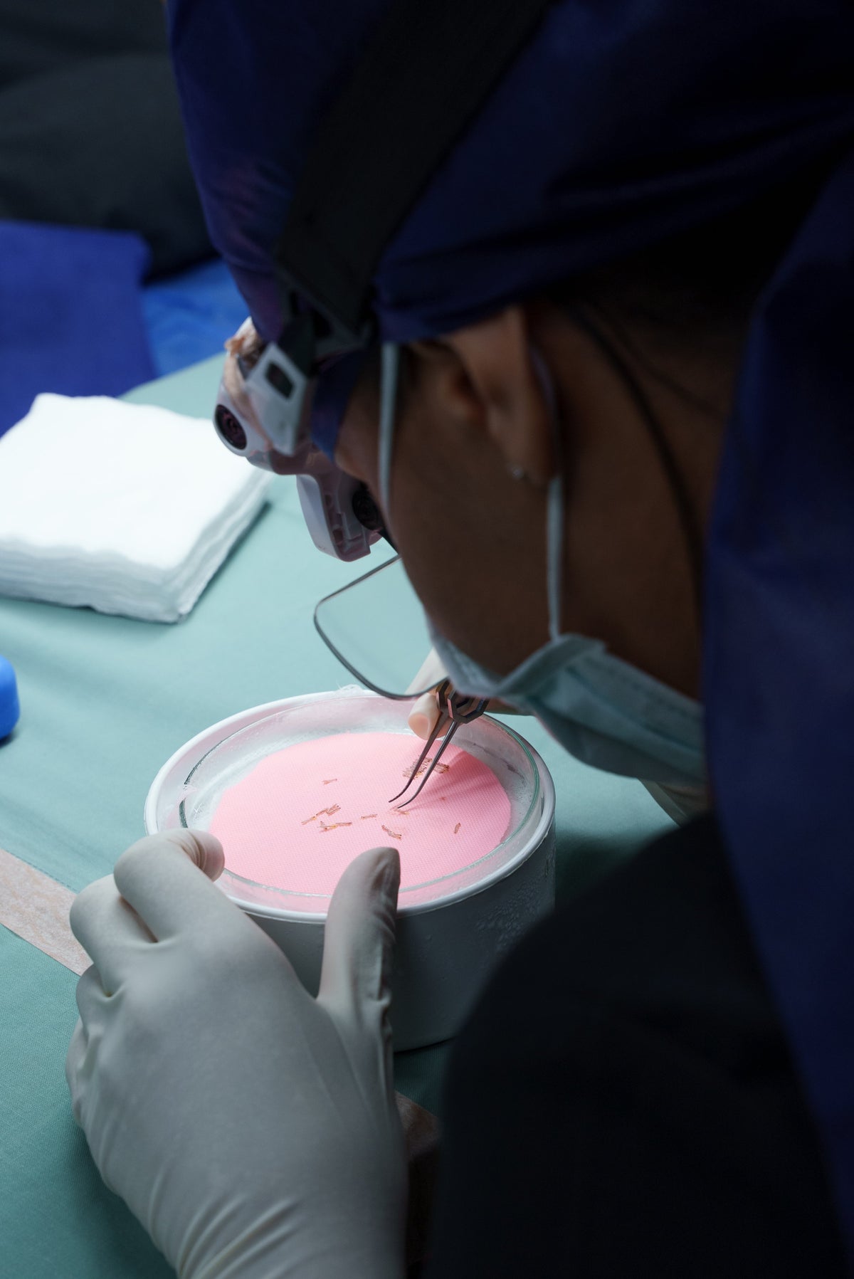 What a Hair Transplant Day  Looks Like