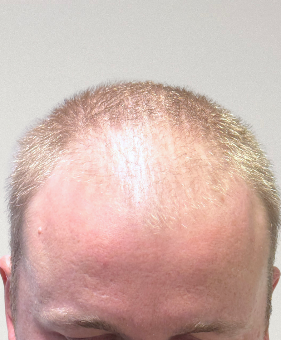 Hair restoration patient before treatment, age 29, thinning, balding
