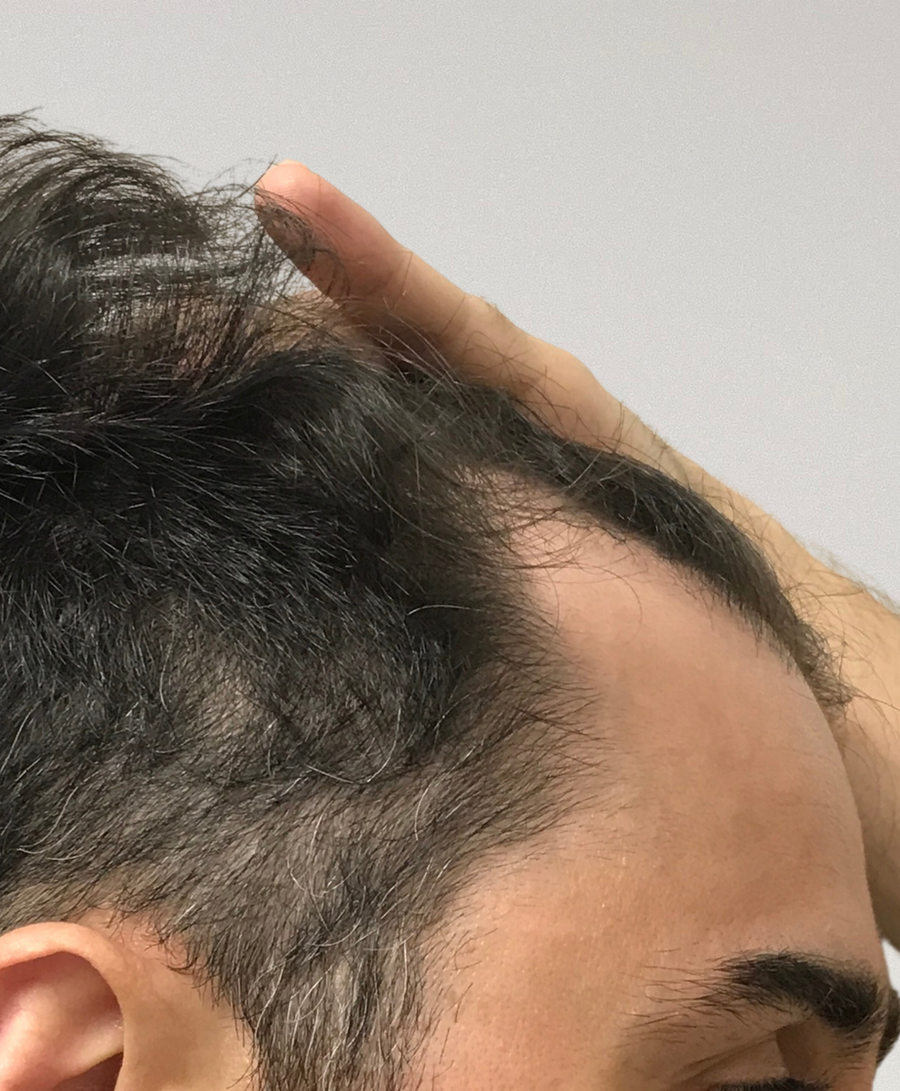 Hair restoration patient before treatment, receding hairline, thinning