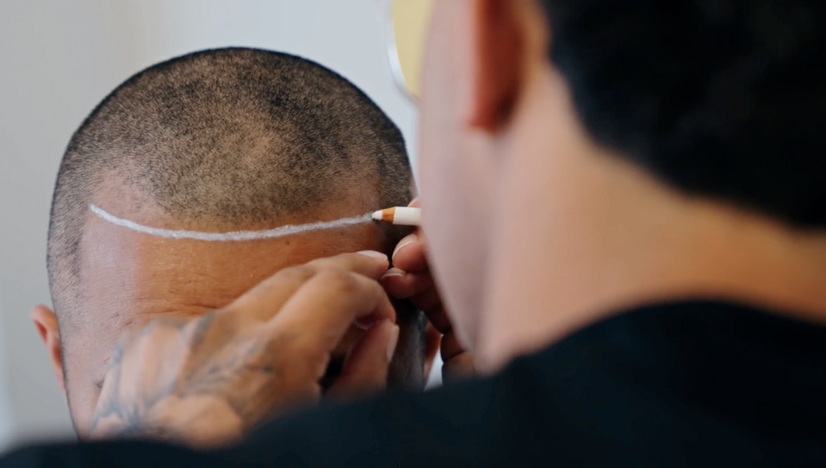 A Gro Auckland doctor performing an FUE hair transplant