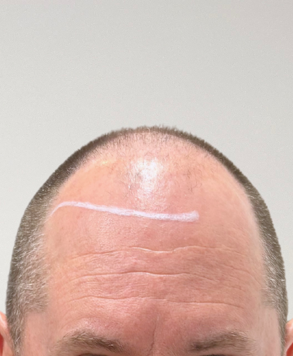 Before treatment