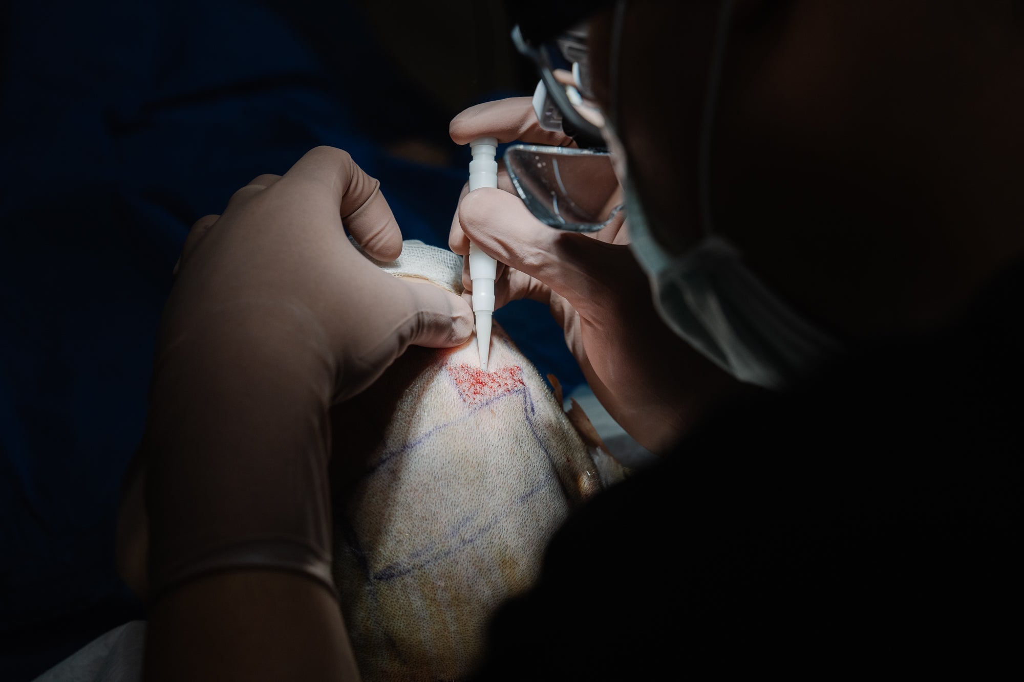 A person wearing gloves, a mask, and glasses is performing a medical procedure, injecting a substance into a patient's scalp. The patient's head is partially covered with a cloth, and the area being treated appears to be marked.