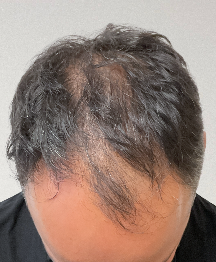 Hair restoration patient before treatment, receding hairline, thinning