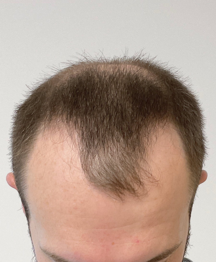 Hair restoration patient before treatment, age 33, receding hairline
