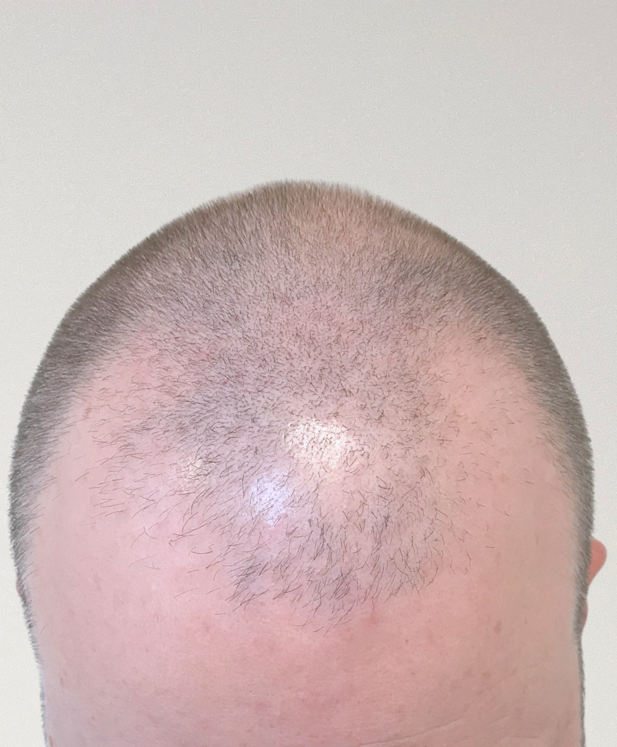 Hair restoration patient before treatment, age 38, receding hairline