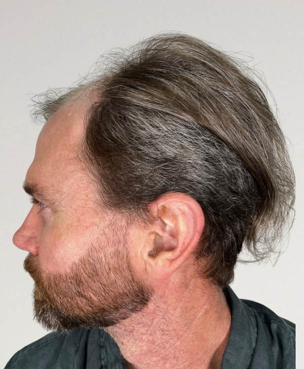 Before treatment