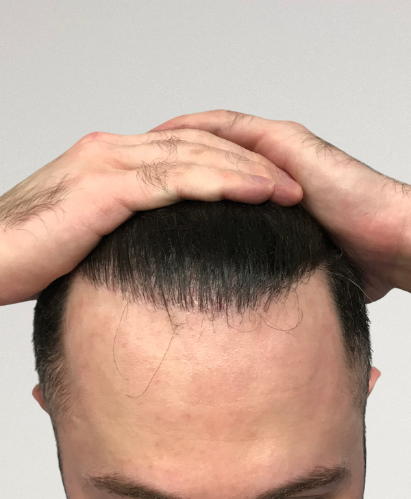 After treatment