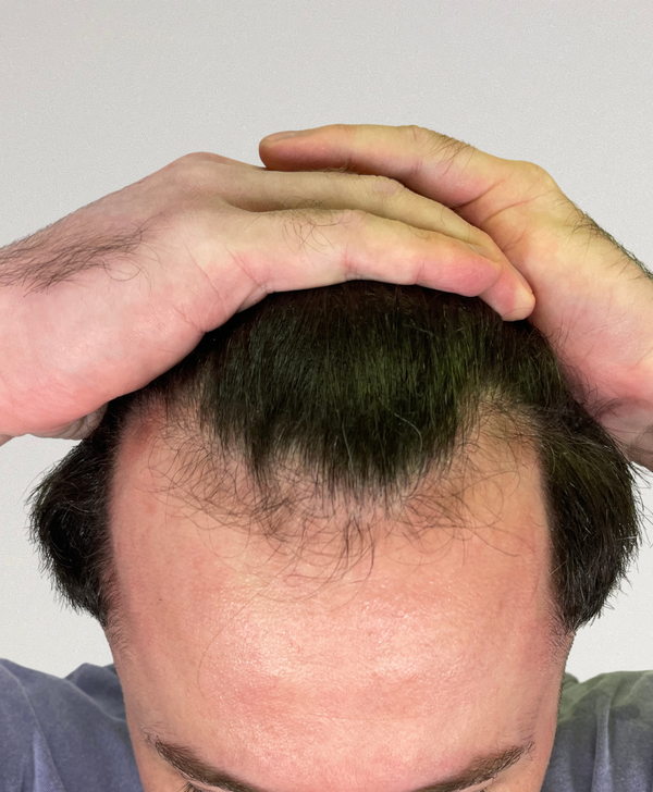 Before treatment