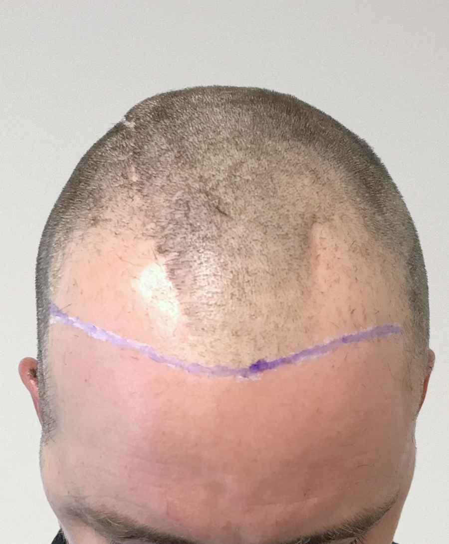 Hair restoration patient before treatment, receding hairline