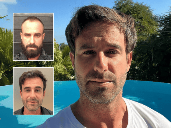 Overall Thinning Transplant