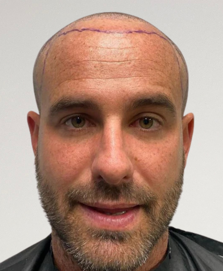 Hair restoration patient before treatment, receding hairline, balding