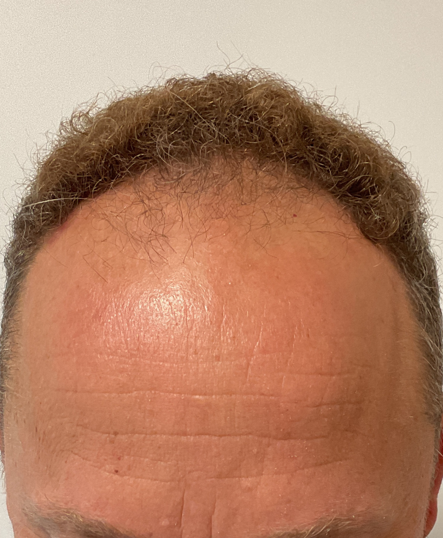 Hair restoration patient before treatment, receding hairline, thinning