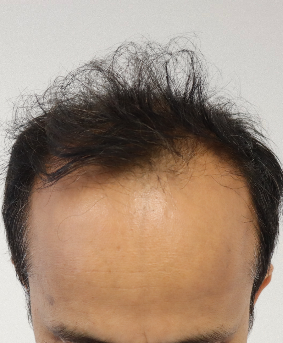 Hair restoration patient before treatment, age 40, thinning