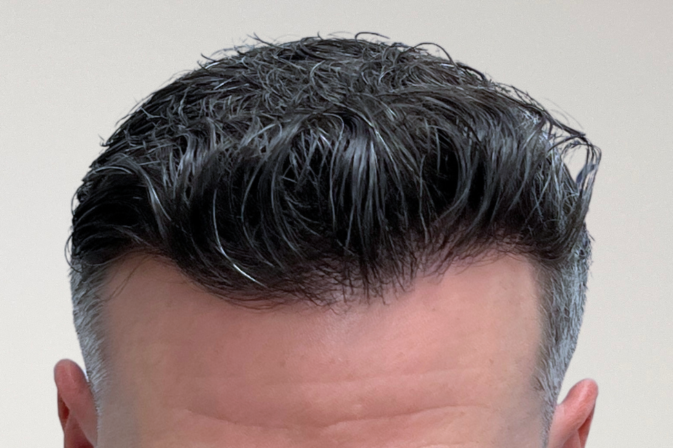 A non-surgical scalp treatment in progress at Gro Auckland