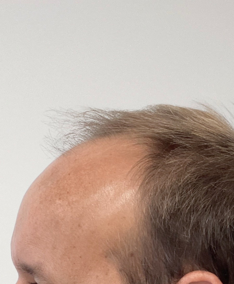 Hair restoration patient before treatment, receding hairline