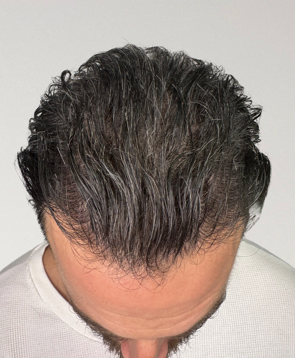 After treatment