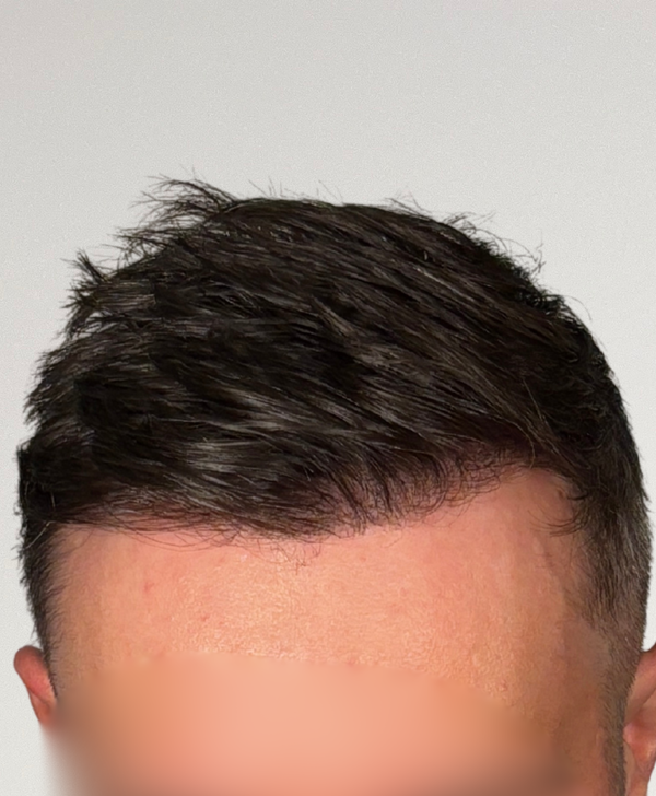 After treatment