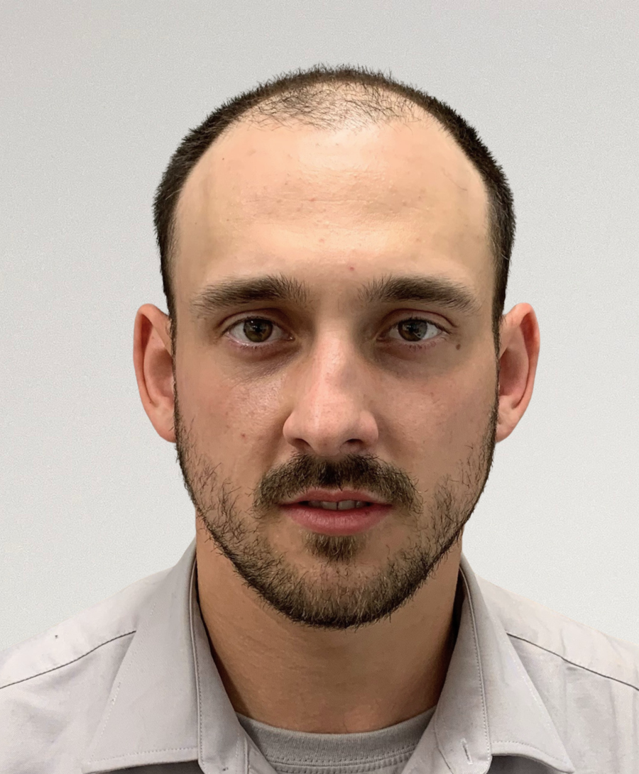 Hair restoration patient before treatment, age 30, receding hairline, balding
