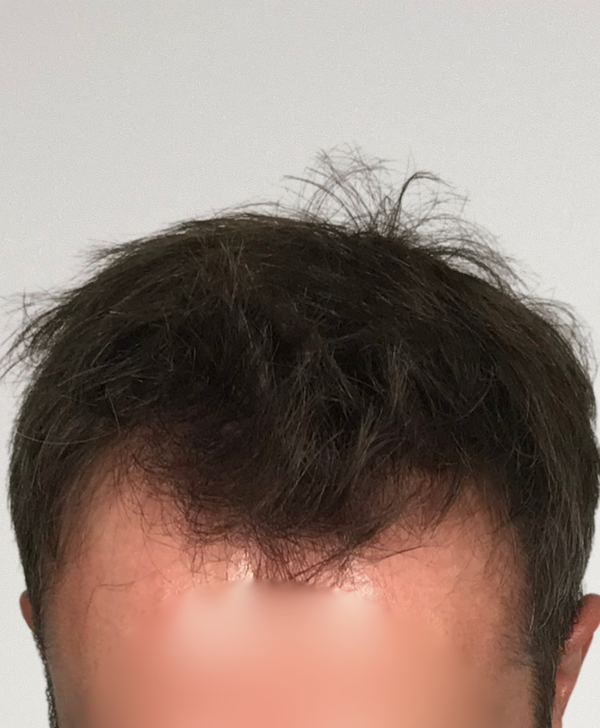 Before treatment