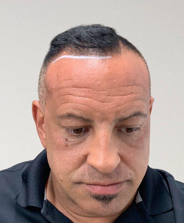 Before treatment